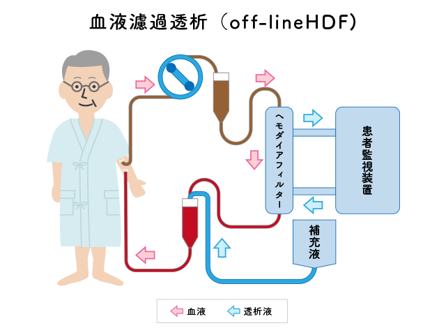 血液濾過透析（off-line HDF）