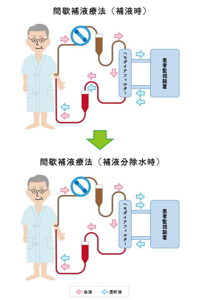 間歇補液療法（i-HDF）