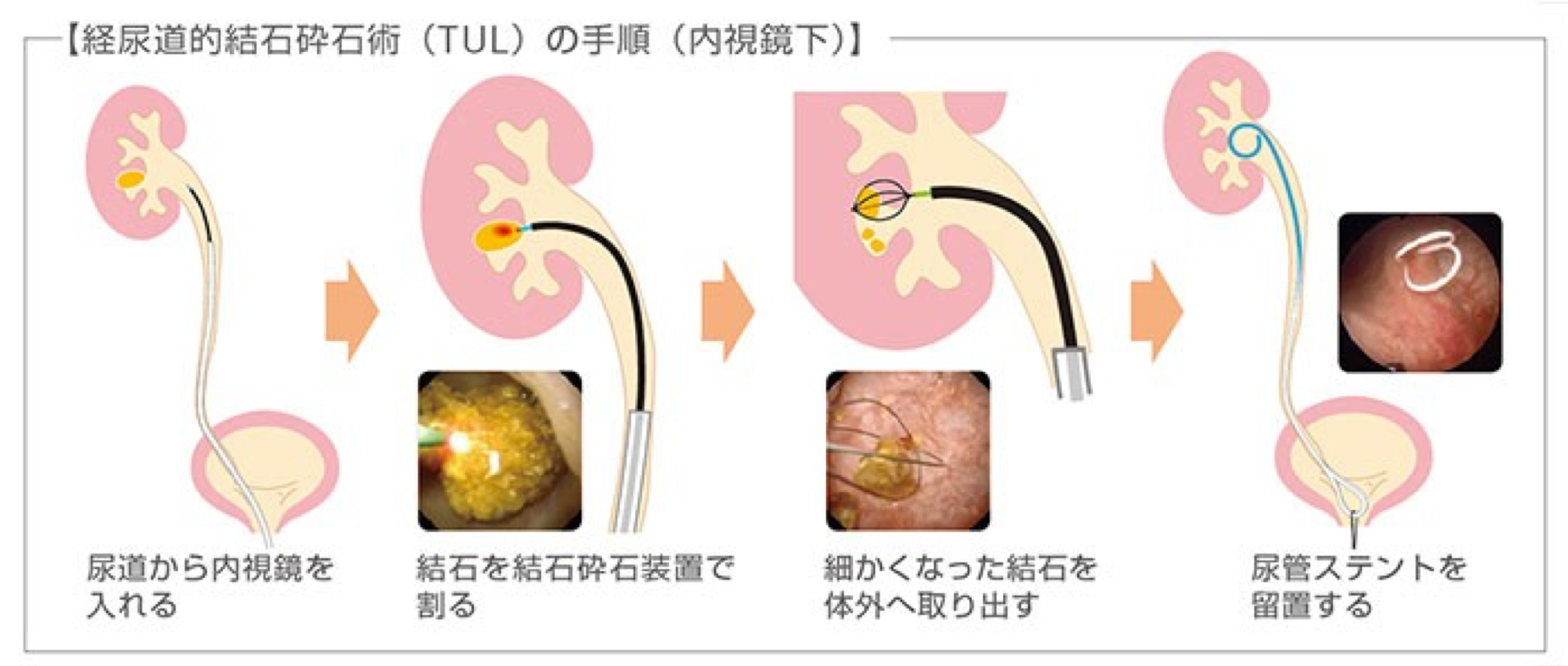 経尿道的結石砕石術（TUL）の手順（内視鏡下）